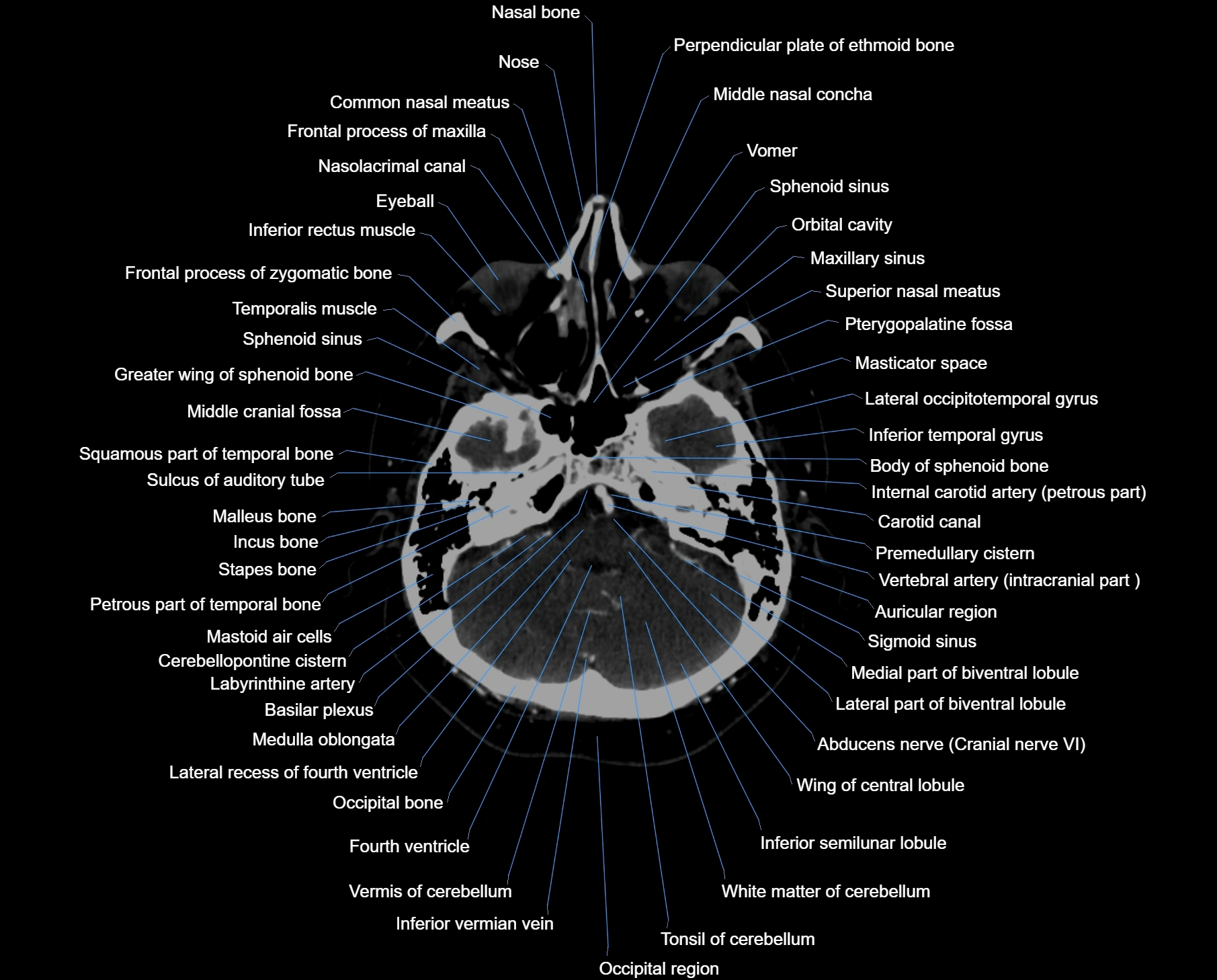 CT scan brain axial labelled cross sectional anatomy image-img-000015.webp